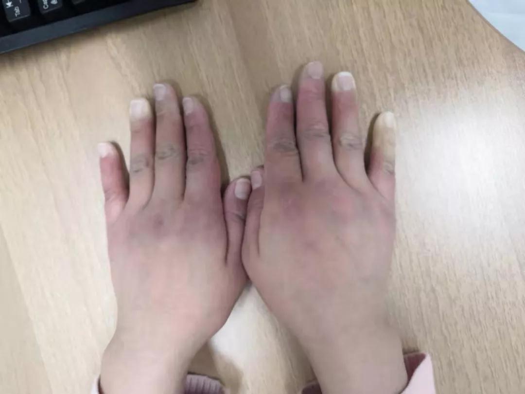 “手指、腳趾發(fā)白、發(fā)紫……”這些“小毛病”千萬(wàn)別大意